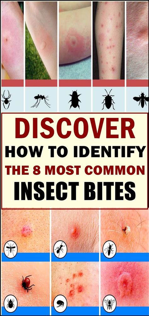 Discover How To Identify The 8 Most Common Insect Bites Insect Bites Insect Bite Remedy