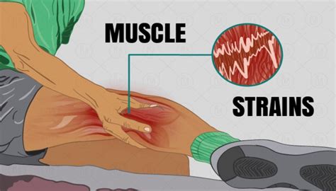 Muscle Strains Symptoms Causes And Treatment Bodybuilding Wizard