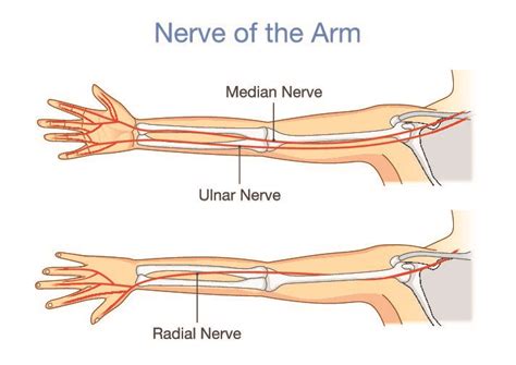 Differentiating Proximal Median Nerve Entrapment From Cts