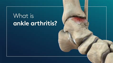 What Is Ankle Arthritis Youtube