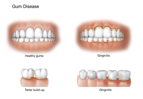 Comparison Of Healthy Gums Versus Gingivitis Poster Print By Trifocal
