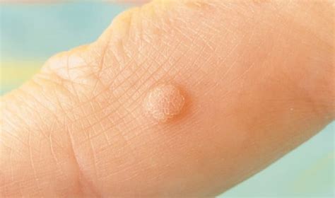 Heres 25 Ways To Naturally Resolve Skin Tags Warts Blackheads Moles