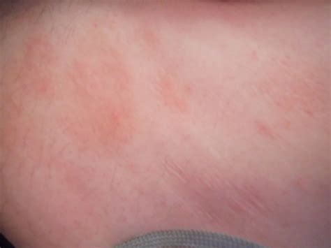 Unexplained Red Rashes All Over Body Other Conditions And General