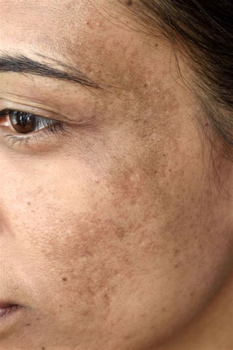 8 Common Skin Problems And How To Fix Them Acne And Rosacea Advice
