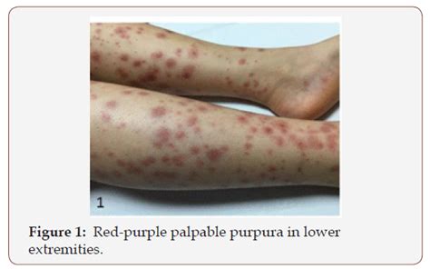 Primary Active Epstein Barr Virus Infection Coexisting With Henoch