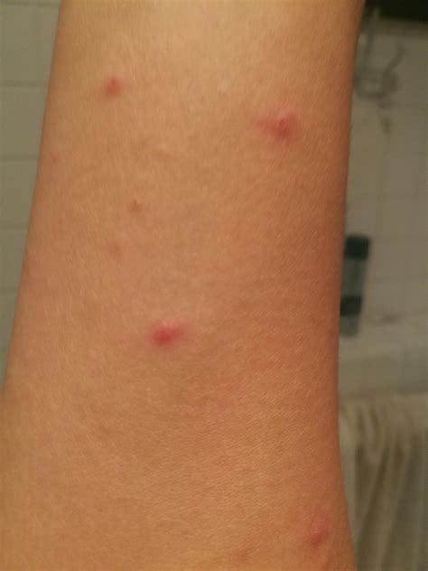 Came Back From Camping And Got These Itchy Bumps Across My Body Anyone