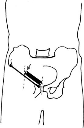 The inguinal ligament extends from the anterior superior iliac spine (asis) to the pubic tubercle. Examination of the groin | Basicmedical Key