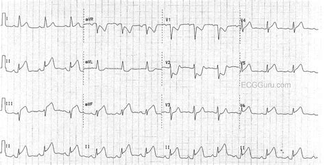 Inferior Lateral And Posterior Wall Mi Ecg Quest