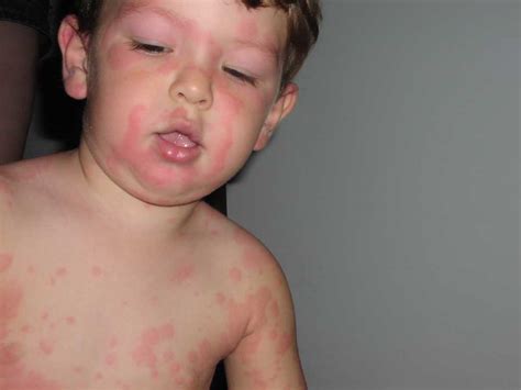Pics Of My Sons Horrible Rash Ever See This Before Any Ideas