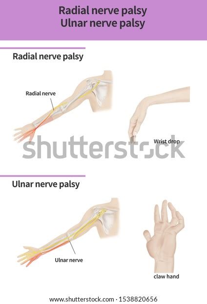 Radial Nerve Palsy Ulnar Nerve Palsy 스톡 일러스트 1538820656 Shutterstock