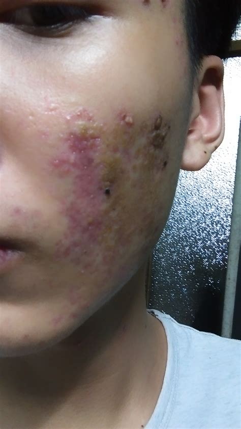 Accutane Side Effects Scars And Redness Prescription Acne Medications