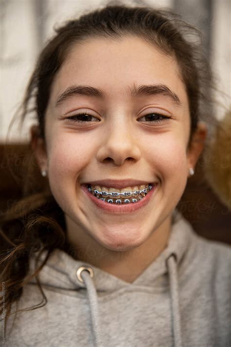 Patient At Orthodontics Office With Braces On Teeth Del Colaborador