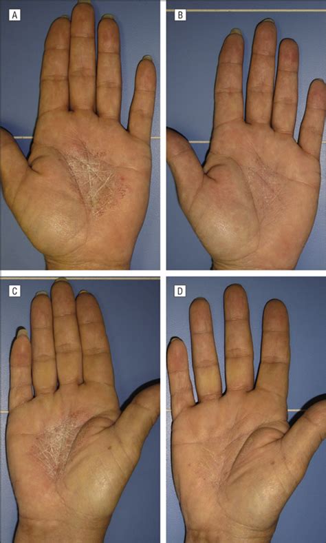 Adalimumab For Treatment Of Moderate To Severe Chronic Plaque Psoriasis