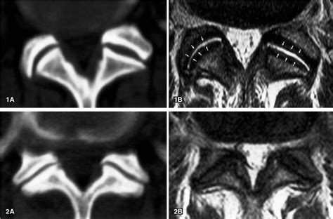 MRI Lumbar Spine Arthritis