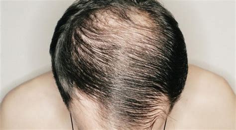 Pernah mengalami mimpi potong rambut? 7 Rahsia Atasi Masalah Rambut Sikit dan Botak | Kini lebih ...
