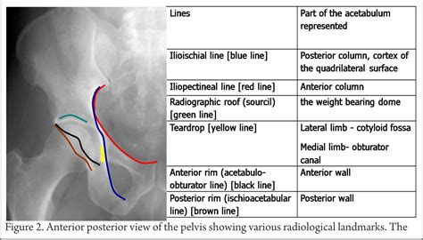 Pelvic x ray lines 6283 figure 3 shentons line pelvic x ray pre operative x ray of the pelvis ap showing fracture Management of Acetabulum Fractures - Basic Principles and ...