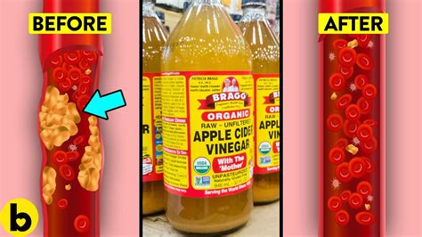 Sebaceous Hyperplasia Apple Cider Vinegar Before And After Apple