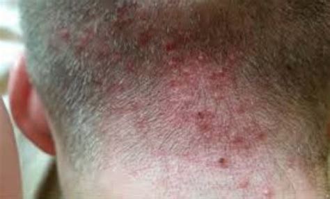 Pictures Causes And Treating Red Bumps On Scalp Best Daily Guide