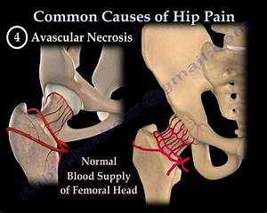 Hip Common Causes Everything You Need To Know Dr