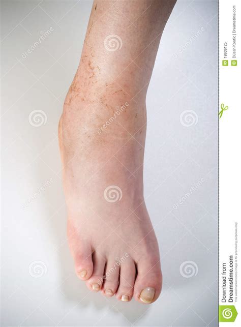 Ankle Sprain Royalty Free Stock Photography 18636125