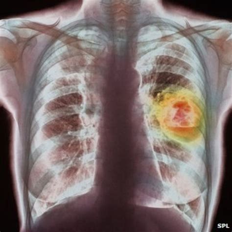 Lung Cancer Drugs Trials Start At Cardiff University Bbc News