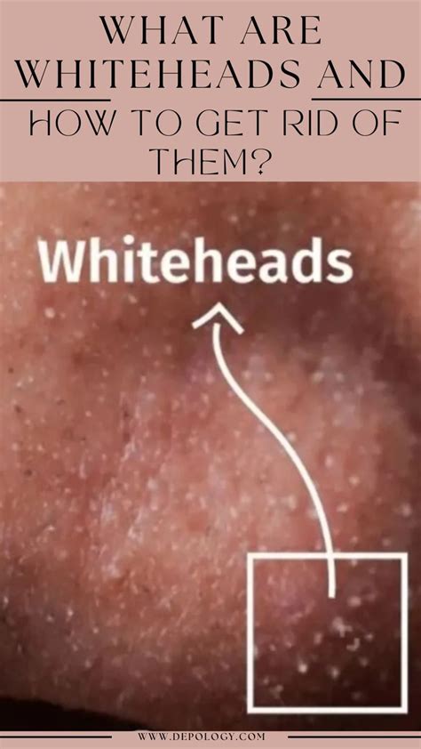 What Are Whiteheads And How To Get Rid Of Them Artofit