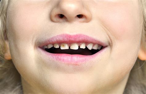 Tooth Decay In Five Year Olds Drops To Its Lowest Level Since 2008