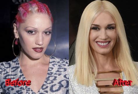 Gwen Stefani Plastic Surgery Then And Now