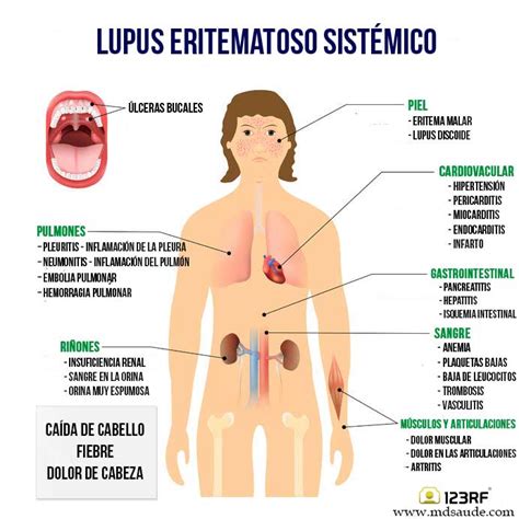 Lupus Eritematoso Sistémico Qué Es Síntomas Y Tratamiento