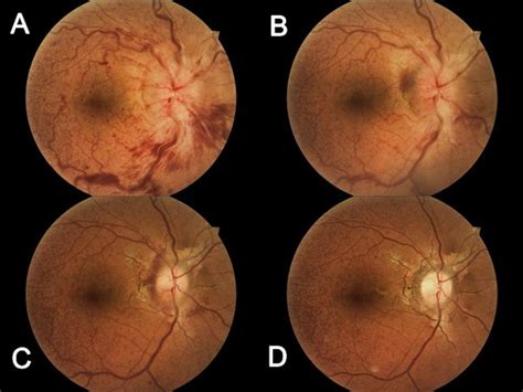 Fundus Photography Of The Macula And Optic Nerve At Initial