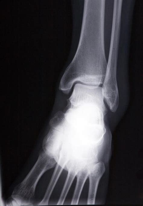 What Is A Cuboid Bone Fracture With Pictures