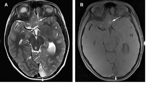 Figure 3 From Cerebral Palsy And Seizures In A Child With Tubulinopathy