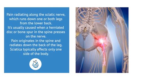 Sciatica A Pain In The Bum Literally Equilibrium Sports And Spinal