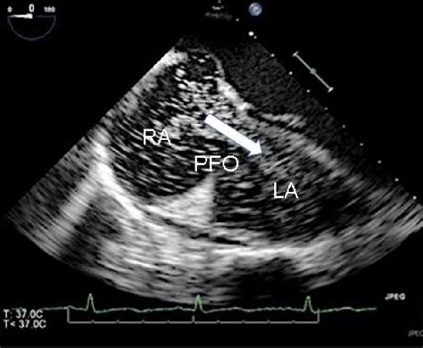 Patent Foramen Ovale Pfo With Right To Left Shunt Of The Agitated