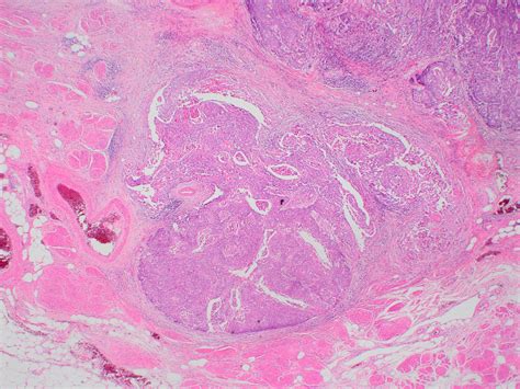 Pathology Outlines Squamous Cell Carcinoma