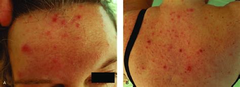 Vesicular Skin Rash Of The Face A And Back B Download Scientific