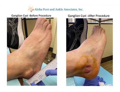 Ganglion Cyst Internal Foot Podiatry Surgery