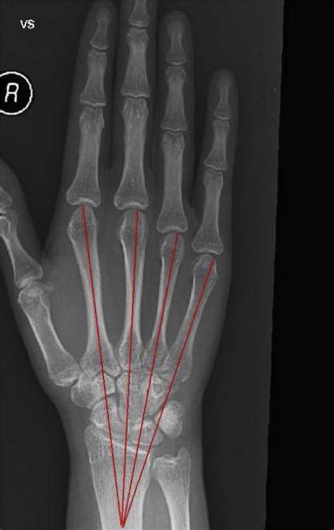 A Review Of Published Radiographic Indicators Of Carpometacarpal
