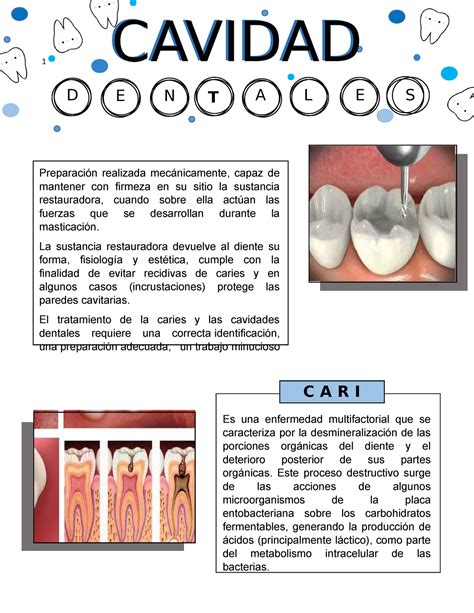 Cavidades Dentales Apuntes Que Son Tipos Clasificacion Tecnicas De