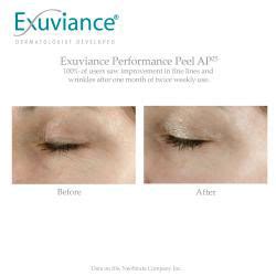 Performance peel ap25 goes beyond skin surface benefits of exfoliating dead, dull surface layers to stimulate the process of cell renewal among. Review - Exuviance Performance Peel AP25 Delivers New Skin ...