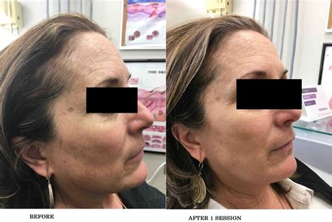 Bbl Before And After Photos Patient 9 Washington Dc Mi Skin Dermatology Center Melda Isaac Md