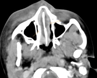 Nasal Septal Abscess CT Sumer S Radiology Blog