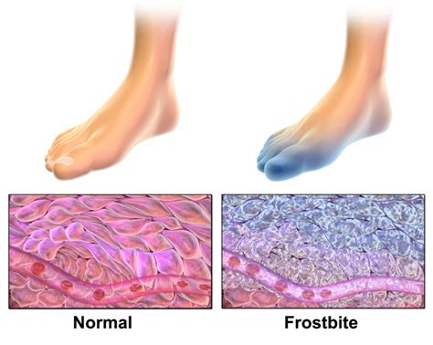 Frostbite Symptoms Prevention And Treatment Caruso Foot And Ankle