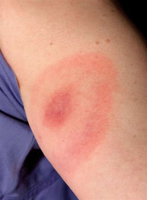 Black widow spider bites are rarely fatal when treated. Spider Bite Treatment: 6 Home Remedies to Try - TheGearHunt