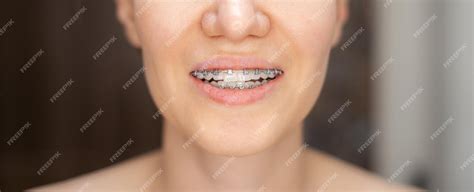 Улыбка молодой и красивой девушки с брекетами на белых зубах выпрямление кривых зубов с помощью