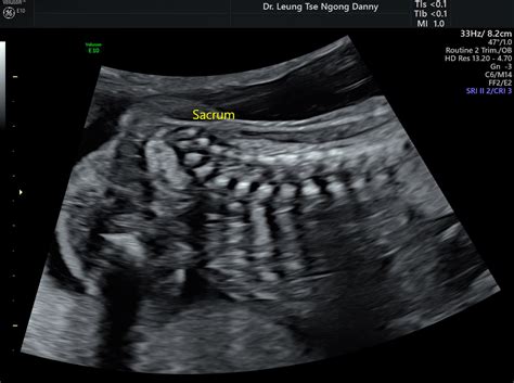 Routine Fetal Morphology Scan Hkog Info