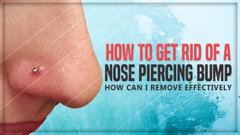 Nose Piercing Bump 5 Simple Remedies To Get Rid Of It At Home Youtube