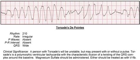 Wide Complex Ventricular Tachycardia Acls Wiki