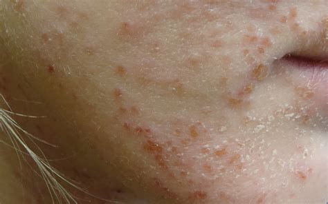 Atopic Eczema In Children Gponline