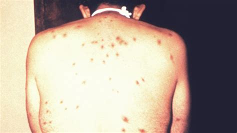Hiv Rash What Does It Look Like And How Is It Treated
